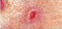 Basal Cell Carcinoma基底细胞癌