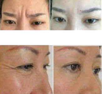 wrinkle-2