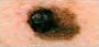 Melanoma黑色素瘤